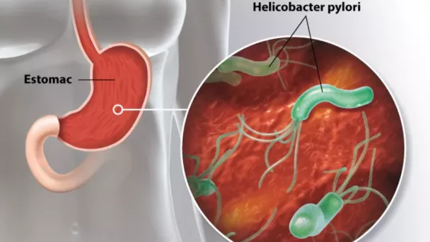 infection à Helicobacter pylori